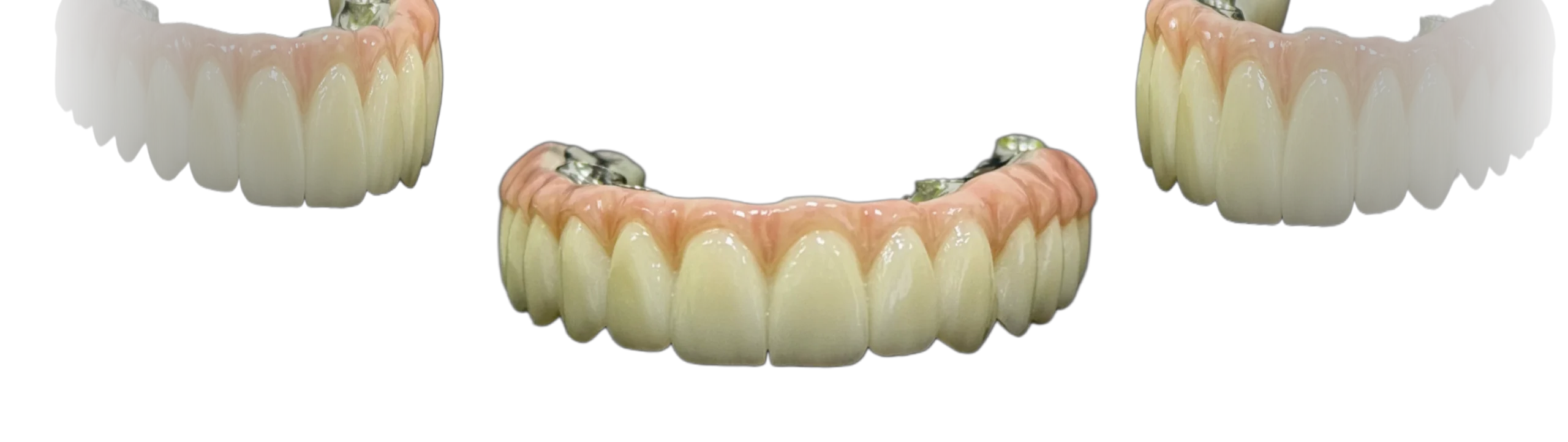 Ортопедичні конструкції на імплантах