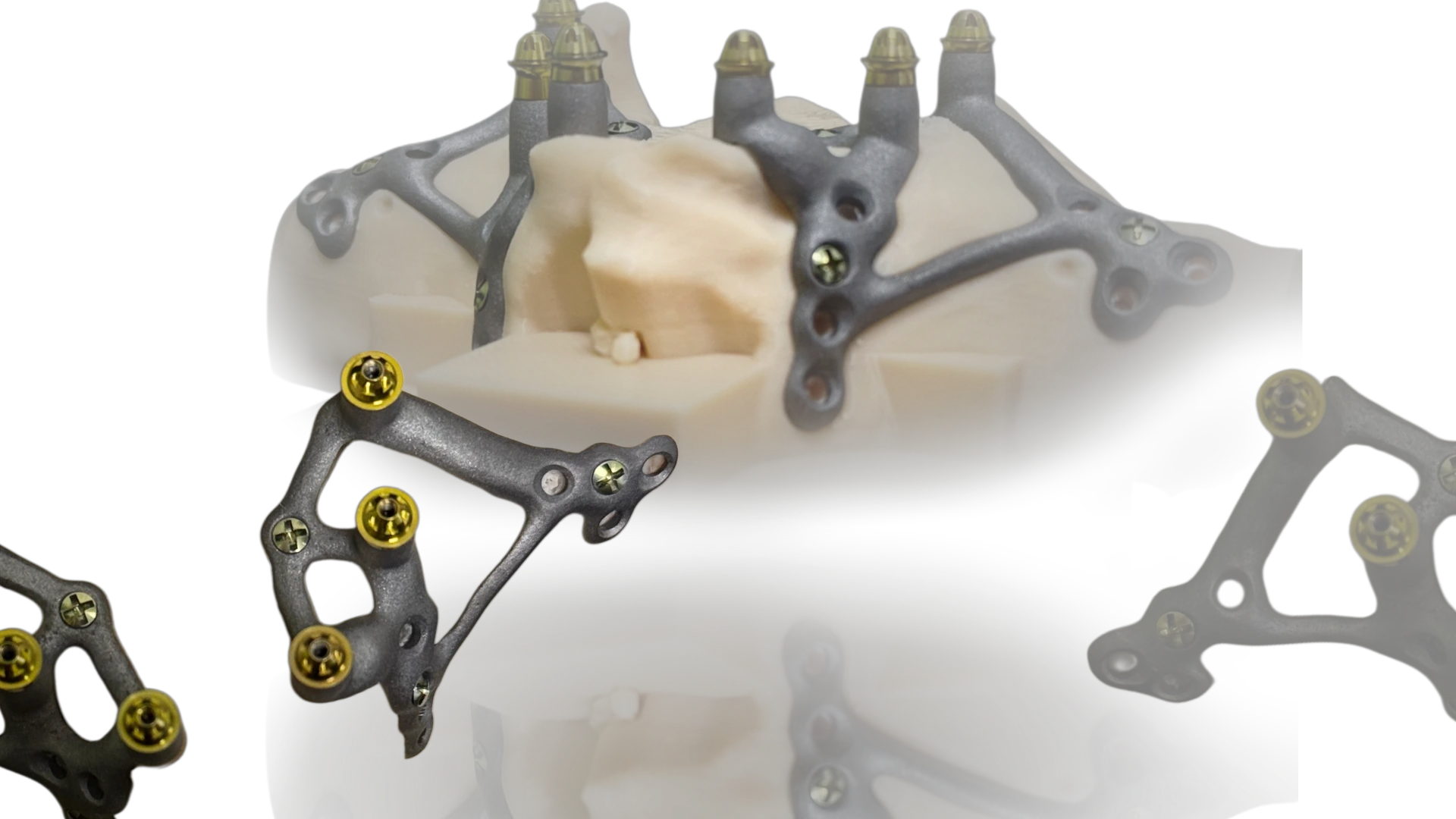 Субперіостальний  імплант