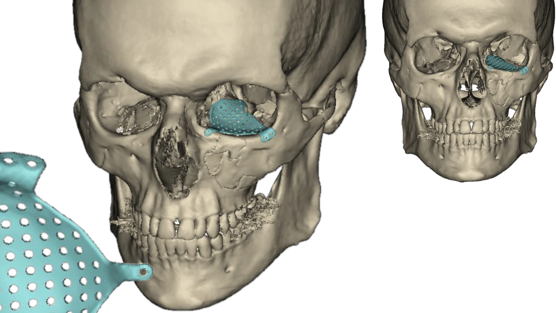 Орбітальна  хірургія