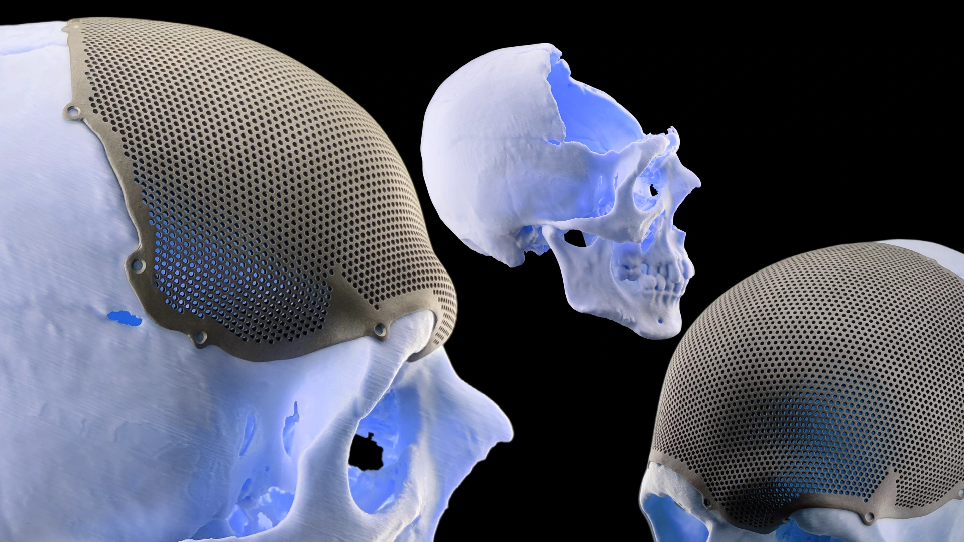 Краніопластика