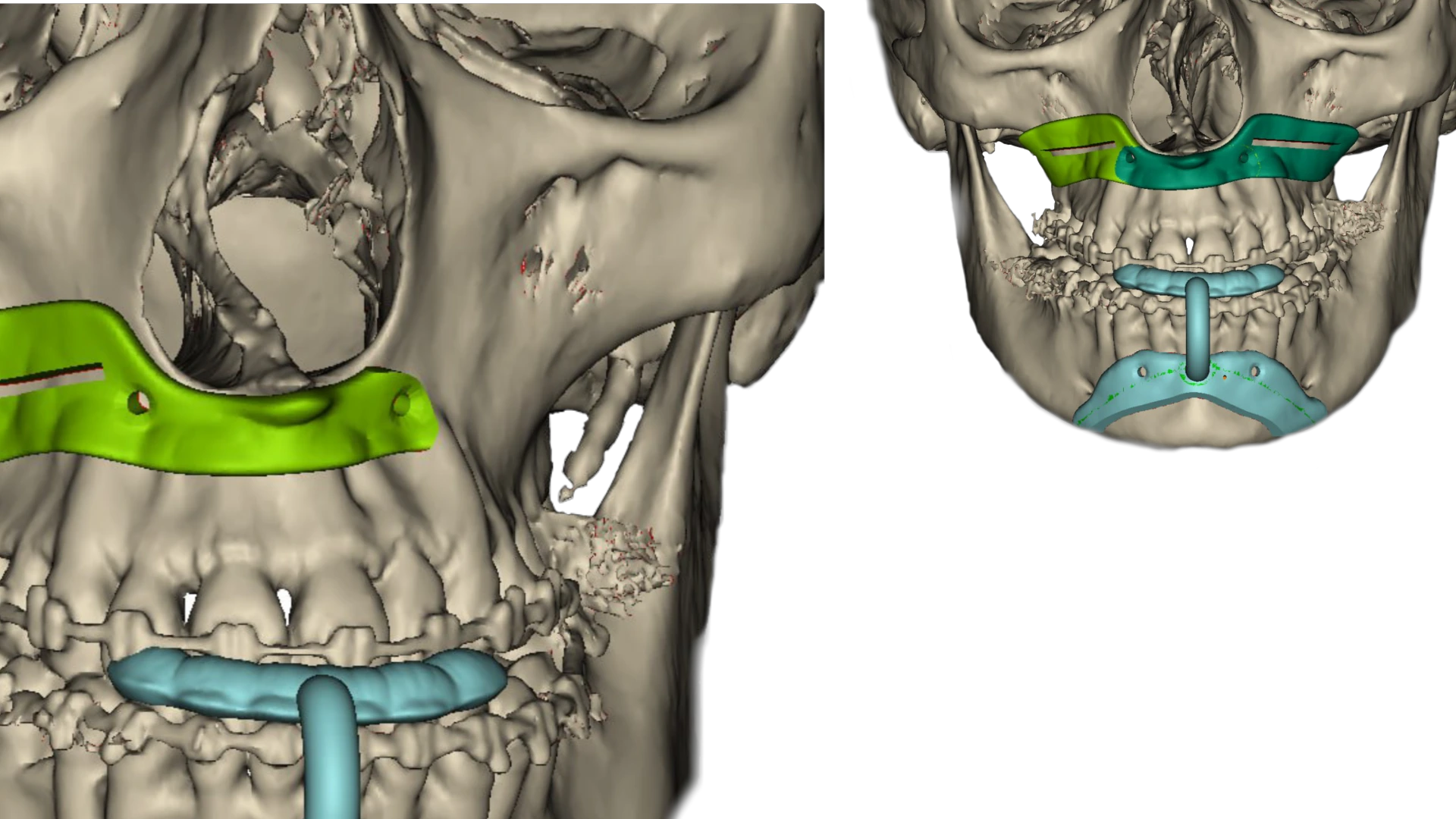 Ортогнатична  хірургія
