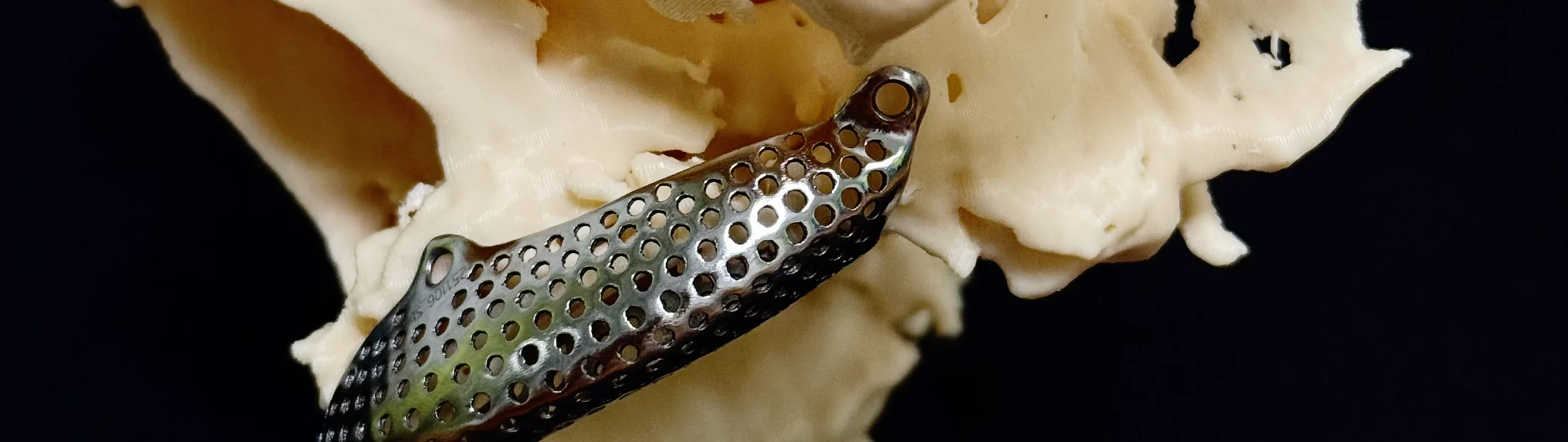 Титанові сітки для аугментації