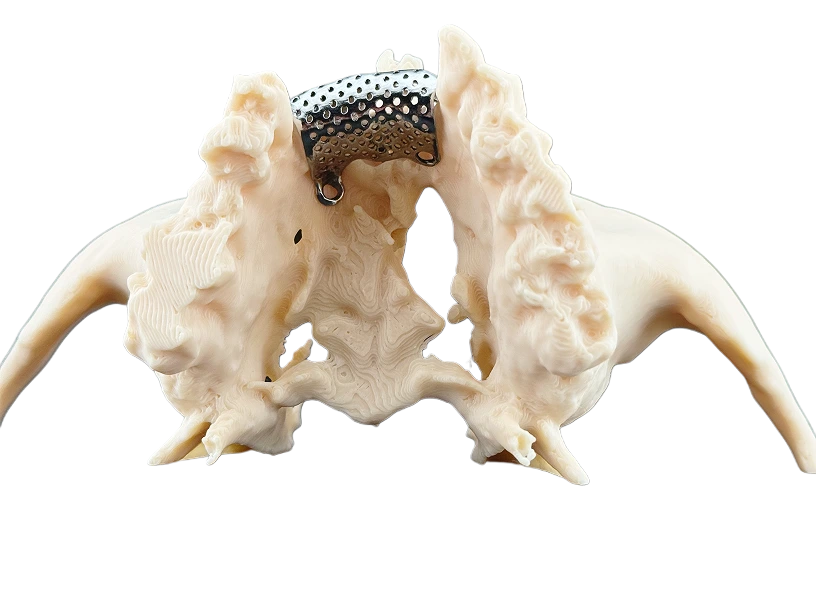 Титанові сітки для аугментації