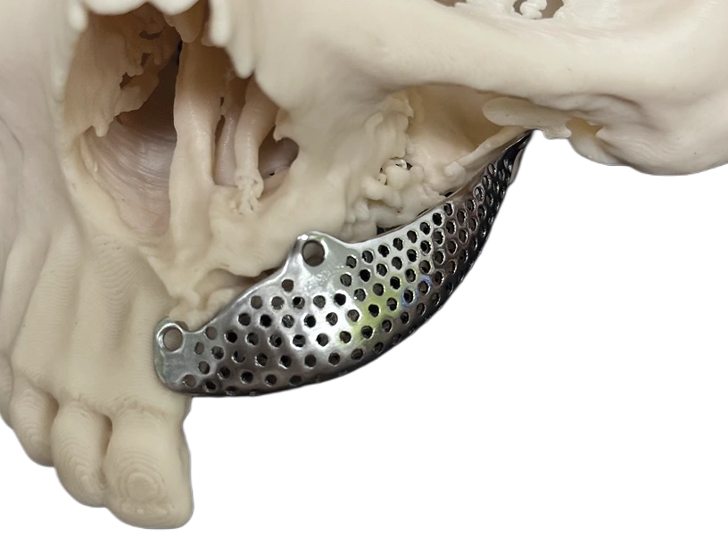 Титанові сітки для аугментації