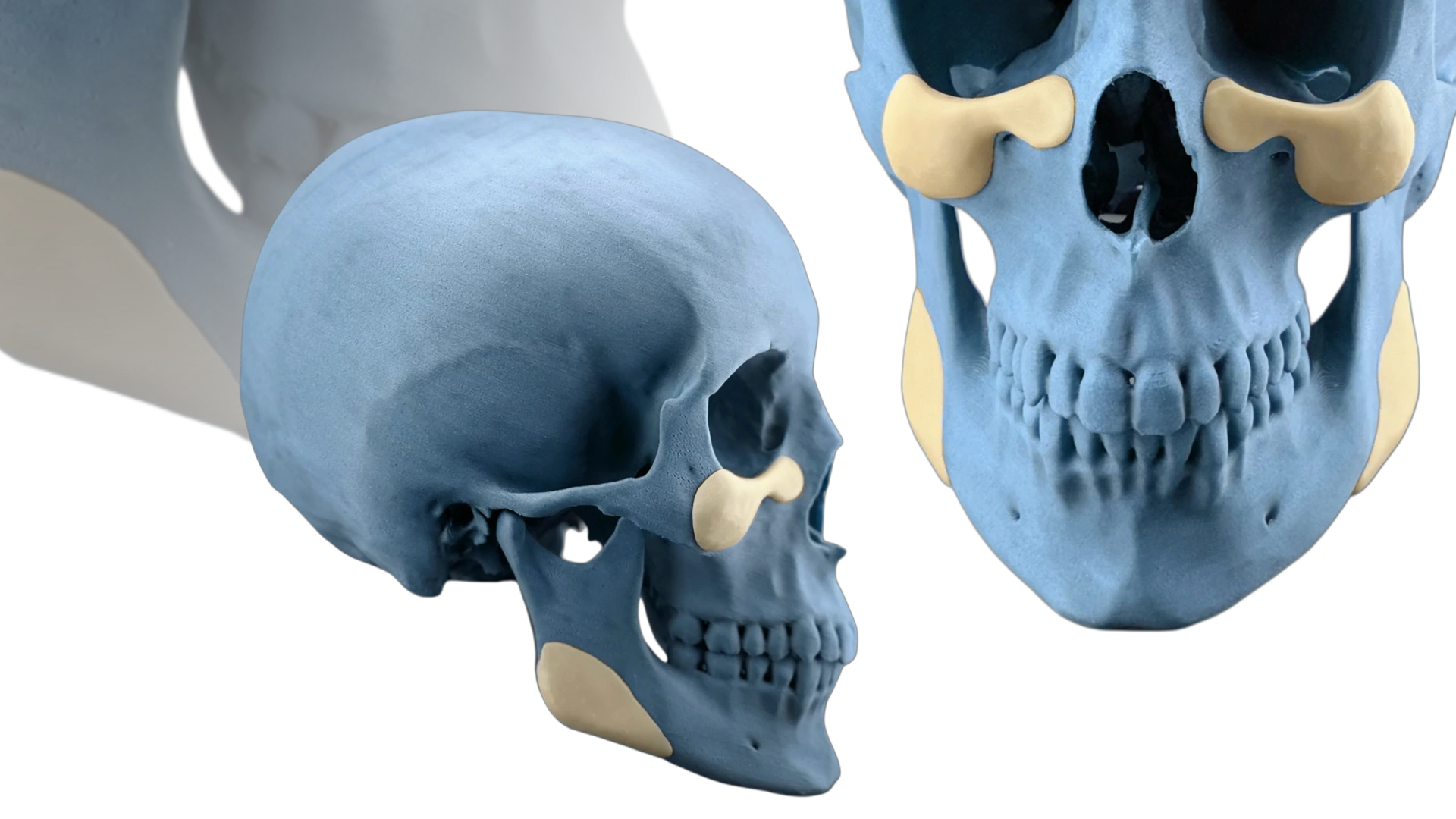 Контурний імплант зони кутів нижньої щелепи