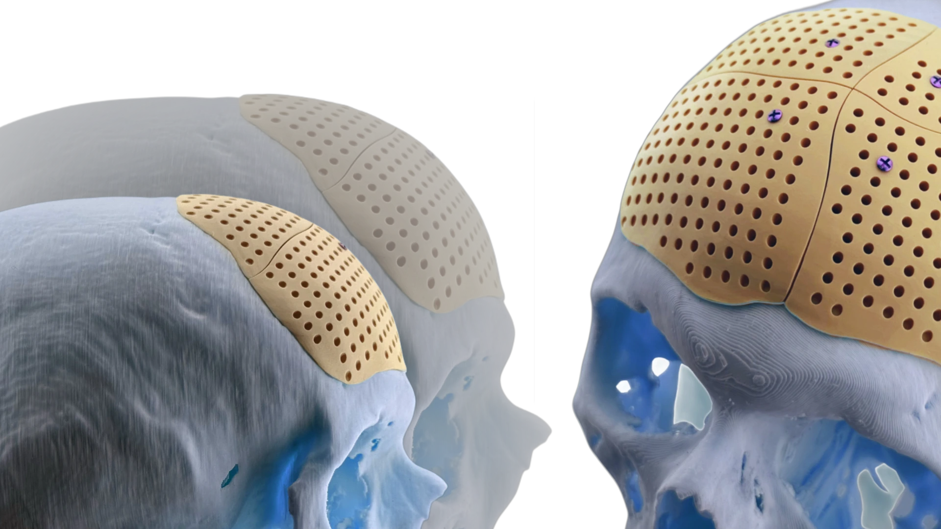 Контурний імплант зони чола