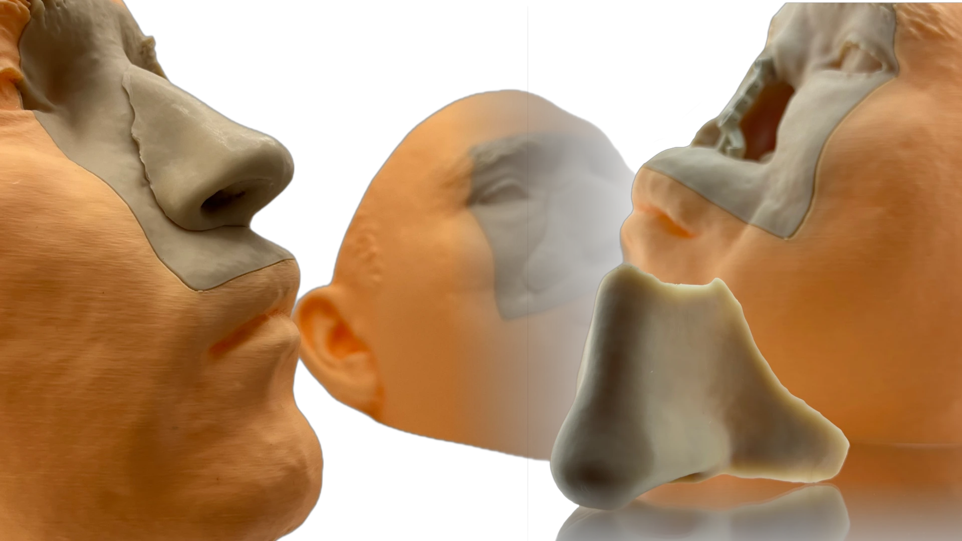 Екзопротезування частин обличчя